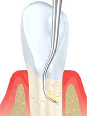 dental_cleaning