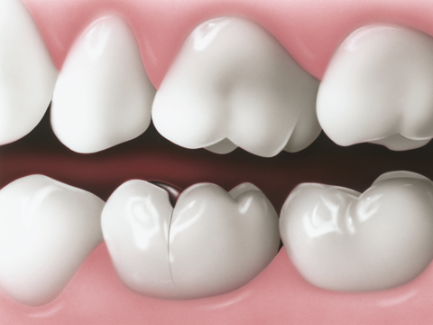 Gigi Geraham Retak atau Patah- Global Estetik Dental Care