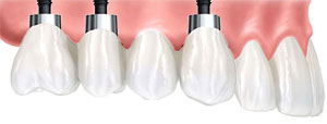 Implant Retained Dental Bridge