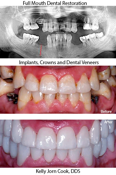 full-mouth-restoration