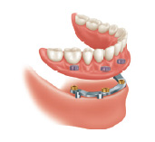 All on 4 - implant retained denture